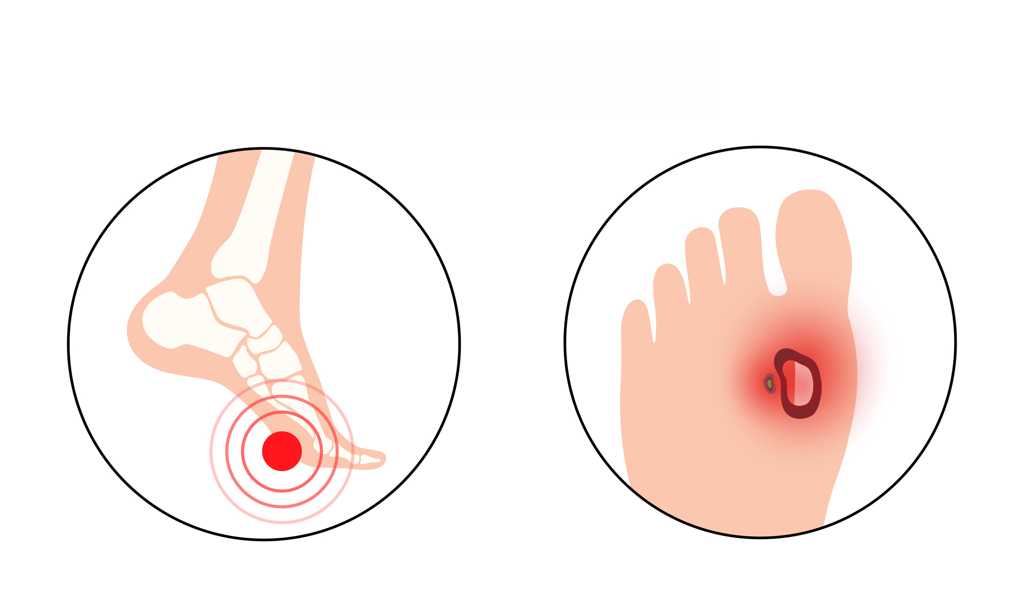 Diabetic foot ulcers | Prevention, grades and management | Urgo Medical