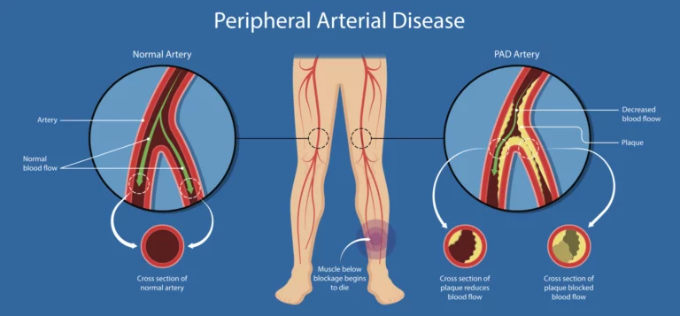 peripheral-artery-disease-pad