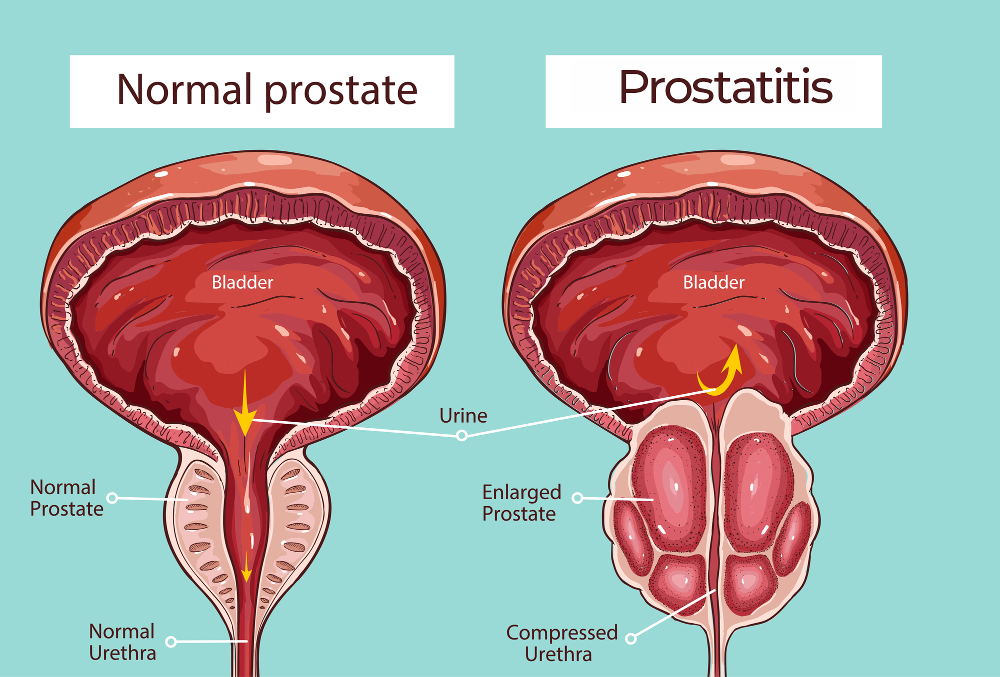 Enlarged Prostate Specialist