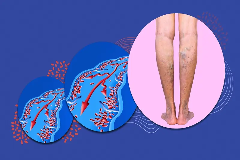 Varicose Veins treatment in LA, CA