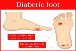 Early Stage Diabetic Foot Ulcer Los Angeles, CA