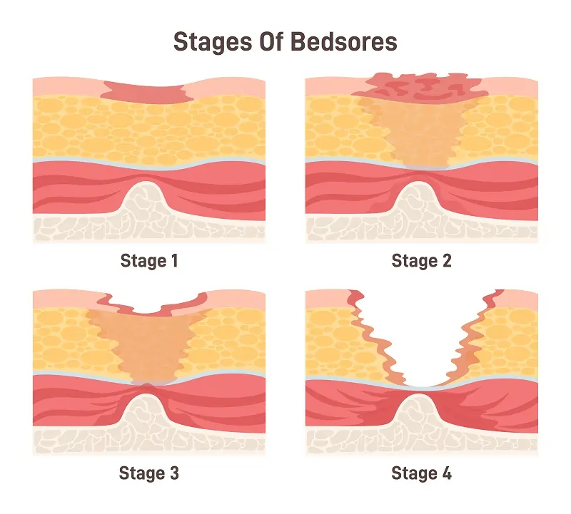 Understanding Bed Sores in Los Angeles, CA