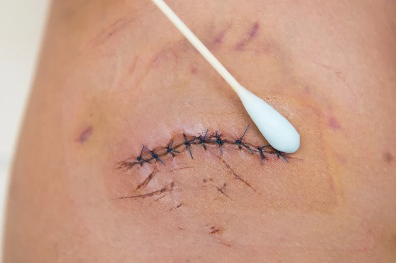 Wound Graft Products Safety in Los Angeles, CA