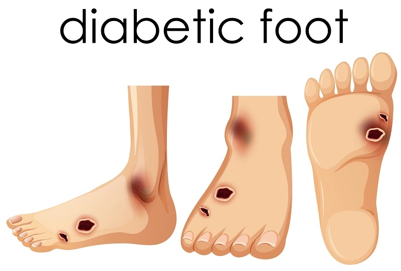 Symptoms of Infected Diabetic Foot Ulcers