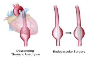 Endovascular Surgery in Los Angeles, CA