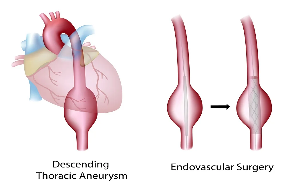 Endovascular Surgery in Los Angeles, CA