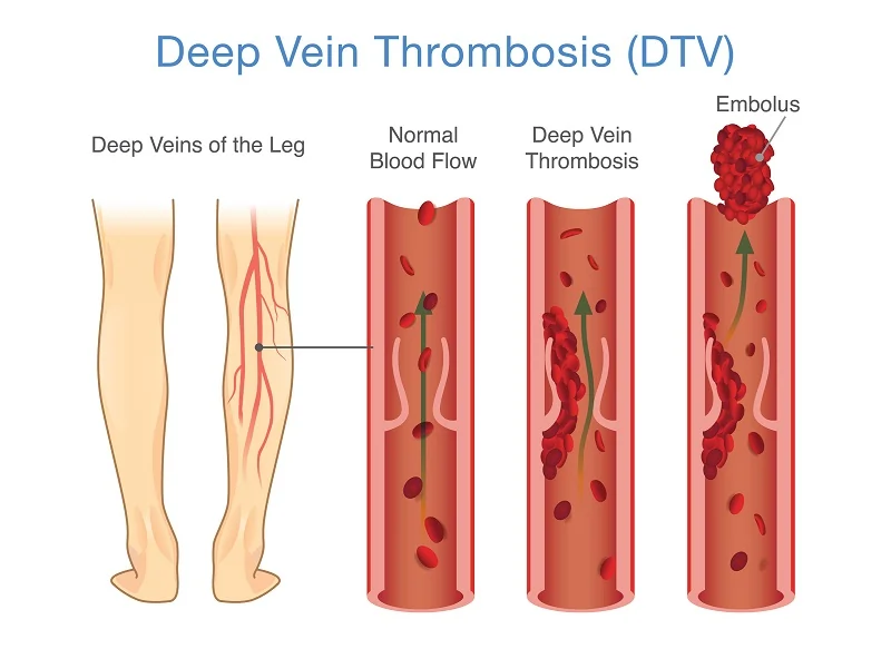 Endovascular Therapy for DVT