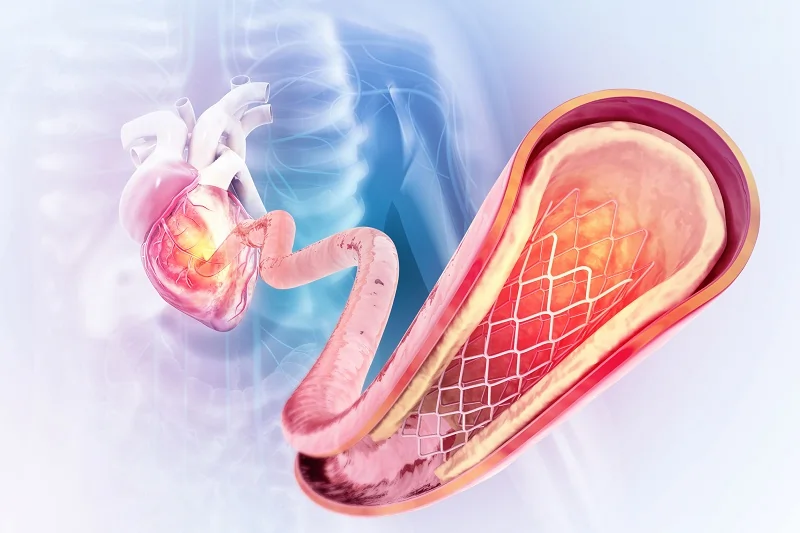 Types of Endovascular Surgery in LA
