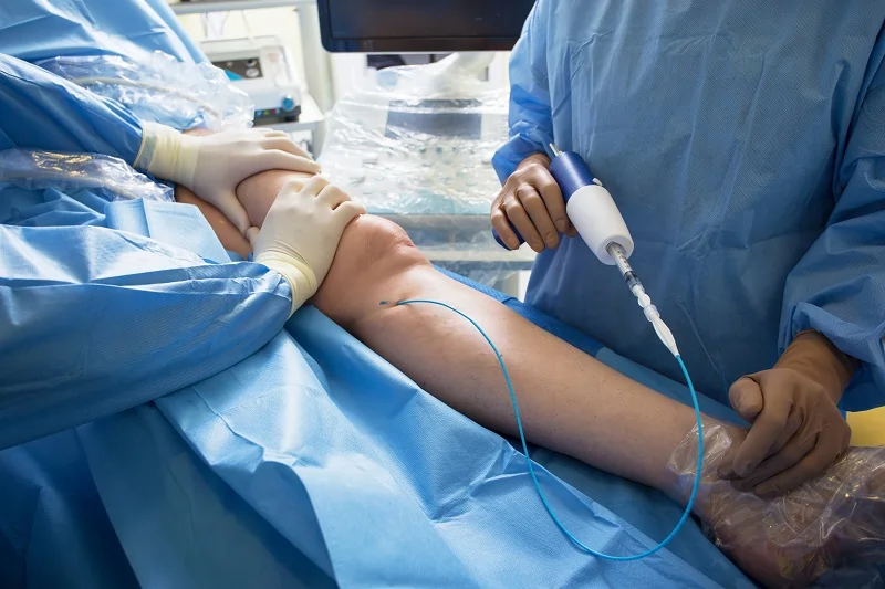 Best Endovascular Surgery: A Minimally Invasive Approach
