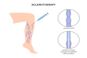 Sclerotherapy in Los Angeles- LA Vascular Specialists