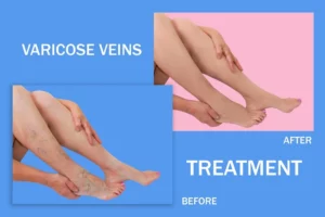 VenaSeal Treatment for Varicose Veins in Los Angeles