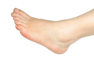 What Is Ankle Discoloration- Insights from Dr. Massoudi in LA