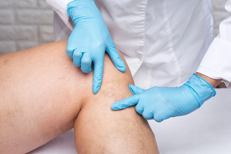 Lymphedema Treatments in Los Angeles