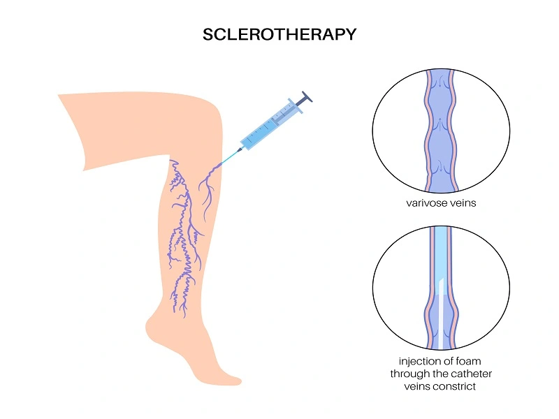 Sclerotherapy In Los Angeles, CA